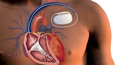 لأول مرة بكفر الشيخ.. تركيب جهاز صدمات قلبية داخل جسم مريض بمستشفى دسوق العام