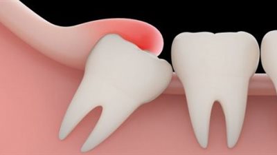 متى يجب خلع ضرس العقل؟