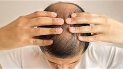 الفرق بين فقدان الشعر الوراثي والمرضي وطريقة العلاج 