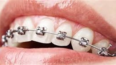 تعرف على أضرار تقويم الأسنان