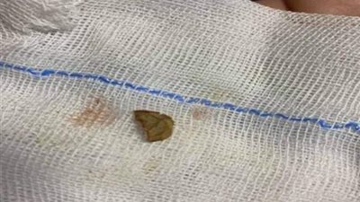 ظلت عالقة لـ 3 أشهر.. استخراج قشرة سوداني من القصبة الهوائية لطفل في بنها