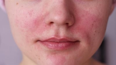 تعرف على طرق علاج التهابات بشرة الوجه