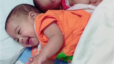 “الاستغاثات الطبية” تنجح في فصل توأم ملتصق بعد سنوات معاناة