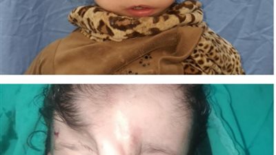 استغرقت 8 ساعات.. نجاح جراحة نادرة لـ”جبهة طفلة” بـ
