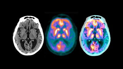 بشرى جديدة في التوصل لعلاج يحد معاناة مرضى ألزهايمر