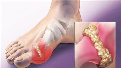 تناول الألياف أبرز العلاجات المنزلية التي تساهم في خفض مستويات حمض البوليك