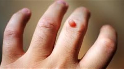 تعرف على مرض الثالول وطرق علاجه