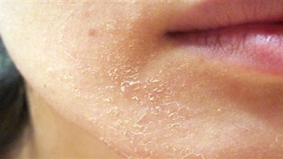 11 نصيحة لمنع جفاف الجلد الشتوي