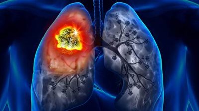 تعرف على أعراض و أسباب سرطان الرئة