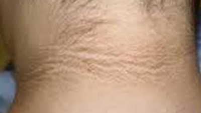 ظهور تلك العلامة خلف الرقبة يدق ناقوس الخطر