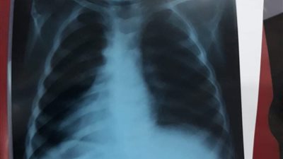 أطباء مستشفى أشمون بالمنوفية يستخرجون 