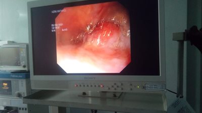 الرعاية الصحية تعلن عن نجاح تركيب دعامة معدنية لمسن تكلفتها 20 ألف جنيه