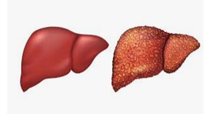 تعرف على الأشخاص الأكثر عرضة للإصابة بسرطان الكبد وطرق علاجه