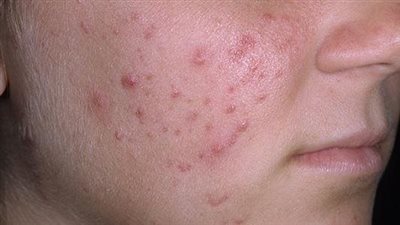 لعلاج حب الشباب.. إليكِ هذا التونر الطبيعي لعلاج المشكلة 