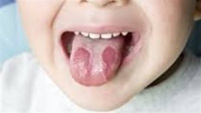 تعرف على نصائح تقليل آلام اللسان المحترق