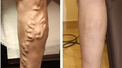 صحة كفر الشيخ توضح أسباب وأعراض دوالي الساقين وطرق الوقاية والعلاج