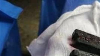 استخراج مشابك غسيل من بطن فتاة حاولت الانتحار في سوهاج