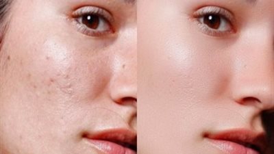 تعرف على سبب ظهور الحبوب تحت الجلد وكيفية علاجها