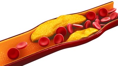 6 نصائح لخفض نسبة الكوليسترول في الدم دون  الحاجة إلى أدوية