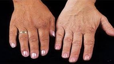 الوهن وفقدان الشهية من أعراضه.. ما هو مرض أديسون؟