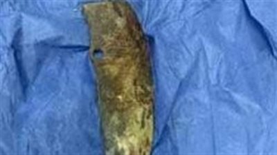 فريق طبي يستخرج ساطورًا من رأس سيدة ضربتها به ضرتها