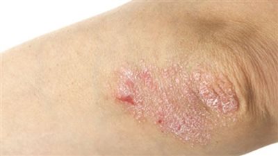 الشعور بالحكة وتغير لون الجلد.. أسباب وعلاج خشونة الكوع