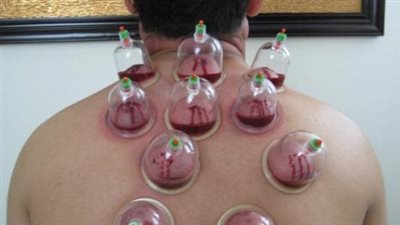 هشام الخياط: العلاج بالحجامة جهل وخرافة وضد الدين