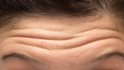 من بينها بياض البيض.. علاجات طبيعية لجعل خطوط الجبين أقل وضوحًا