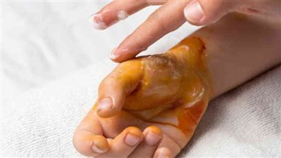 تعرفي على أهم الإسعافات الأولية التي يجب إتباعها عند الإصابة بحروق