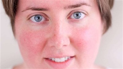 طرق طبيعية للتخلص من احمرار الوجه