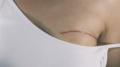 بعد الاستئصال..ما هي فوائد عملية ترميم الثدي