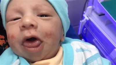 أحدهما تناول مادة عطرية.. تفاصيل تسمم رضيعين بالشرقية