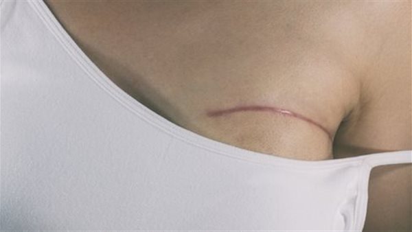 ترميم الثدي (أرشيفية)