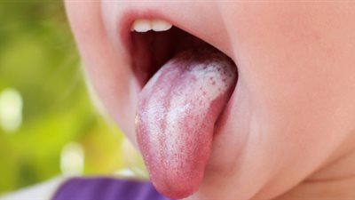 منها التشققات.. أعراض فطريات الفم عند الأطفال