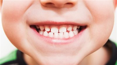 وسط جدل علمي.. أمريكا تبدأ سحب مكملات الفلورايد المستخدمة في الوقاية من التسوس للأطفال 