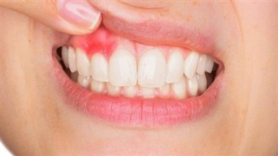 هيئة الدواء: أخذ التهاب اللثة بجدية ومعالجته دون إبطاء