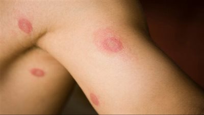 تزامنا مع الأجواء الحارة.. تعرف على أهم 8 نصائح لتجنب الفطريات الجلدية في الصيف 