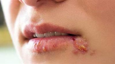 دراسة تحذر سكان بريطانيا من تجاهل لقاح فيروس الهربس