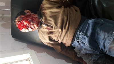 إصابة طالب صدمه جرار زراعي وفر هاربًا بسوهاج (صورة)    