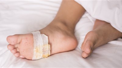 خبراء يكشفون عن نصائح مهمة لمرضى القدم السكري