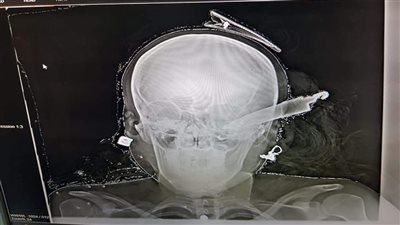 حبس عاطل في المنوفية 15 يومًا بعد تعديه على أمه وغرس سكين في رأس زوجة شقيقه