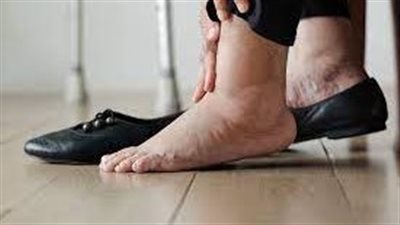 تعرف على طرق علاج احتباس الماء في الجسم