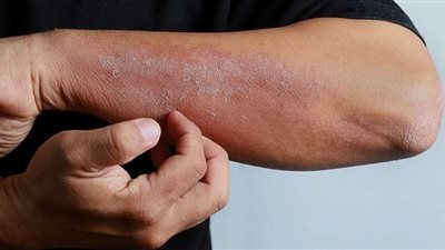 تعرف على أسباب الطفح الجلدي 