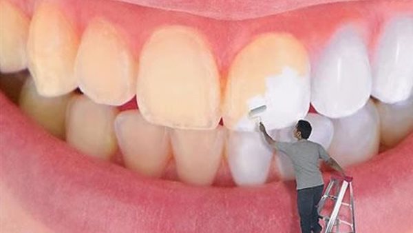  اصفرار الأسنان