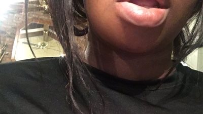 تشوه وجه فتاة بعد تناولها ساندويتش “برجر” (صور)