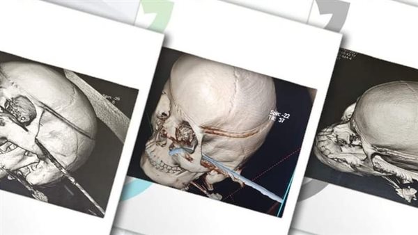 العملية الجراحية