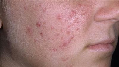 كيفية التخلص من حب الشباب بوصفات منزلية