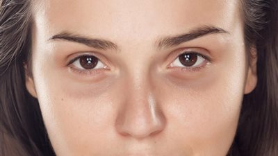  وصفات منزلية تساعد في التخلص من الهالات السوداء تحت العين