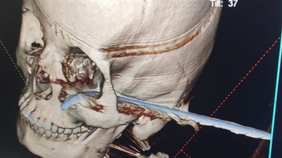 الرعاية الصحية تعلن نجاح مستشفى السلام ببورسعيد في استخراج سيخ حديدي من رأس طفلة (صور) 