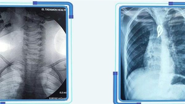 ظهور دلاية السلسلة